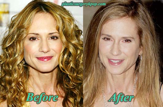 HollyHunterPlasticSurgeryPicture.jpg